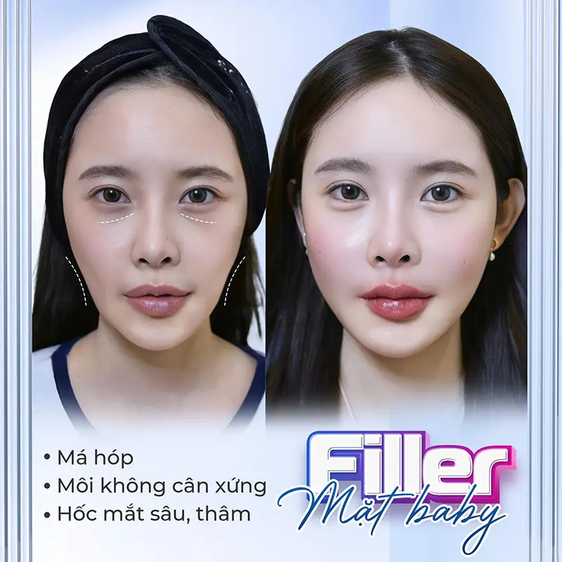 Tiêm filler má giúp làm đầy má, tạo khuôn mặt baby và trẻ trung