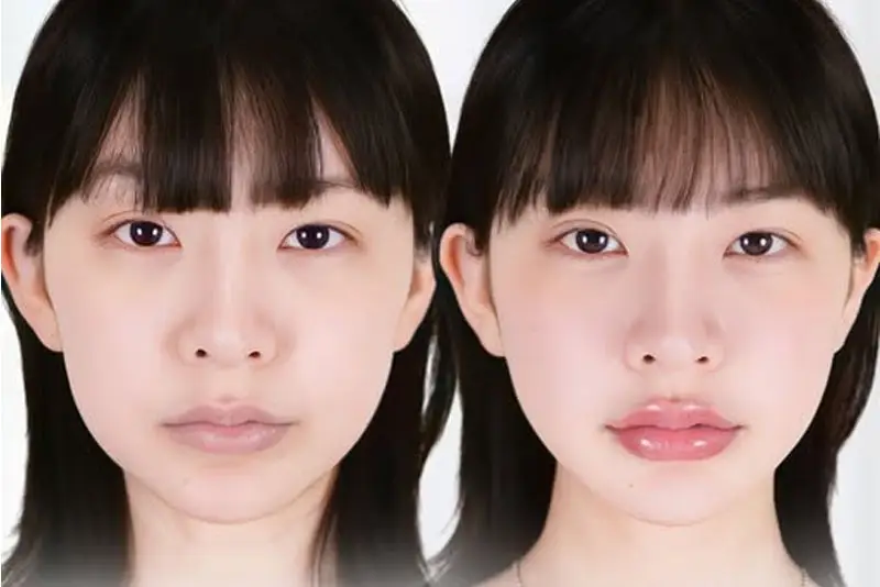 Tiêm filler môi giúp che khuyết điểm vùng môi