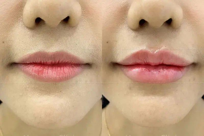 Tiêm filler môi thường có chi phí thấp vì sử dụng lượng filler ít