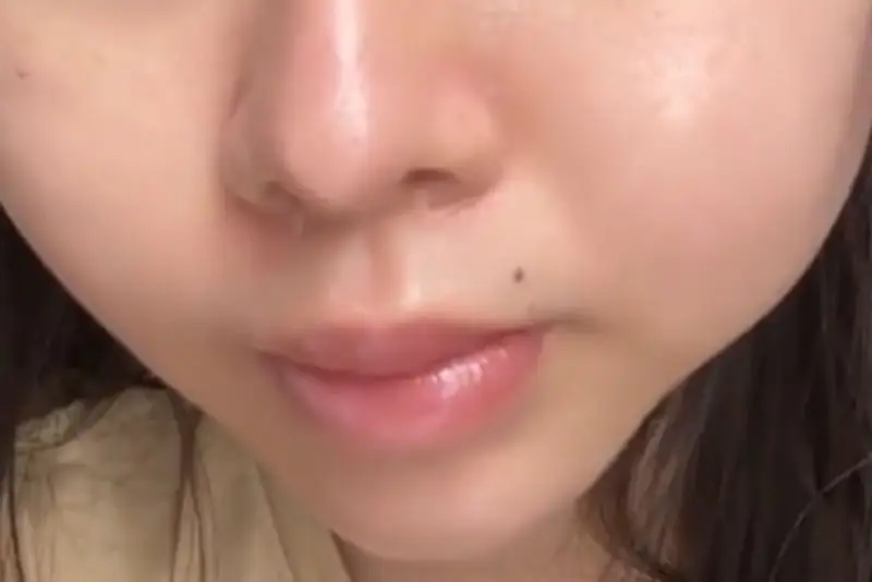 Tiêm filler rãnh cười