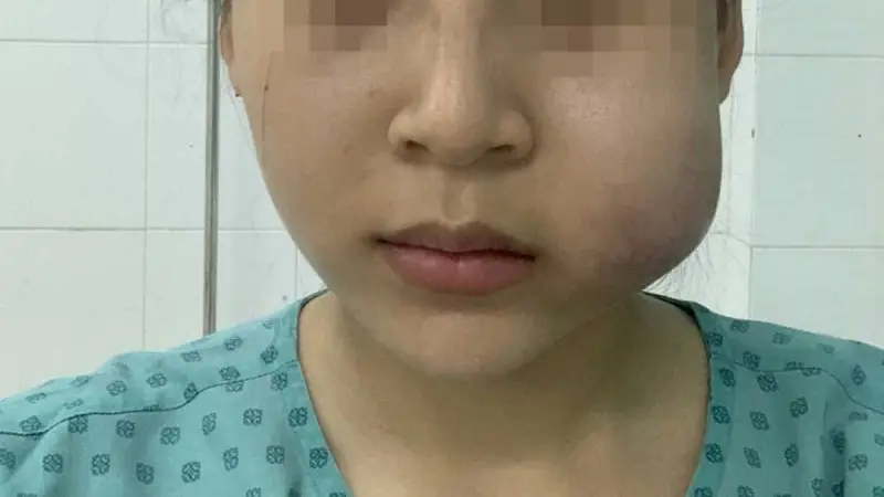 Trường hợp bị sưng do tiêm filler rãnh cười bị tràn sang má