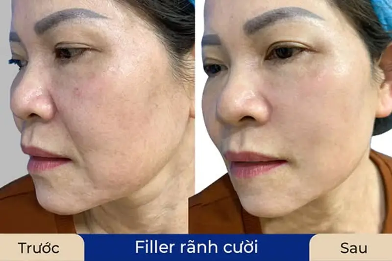 Phương pháp tiêm filler giúp lấp đầy vùng rãnh cười