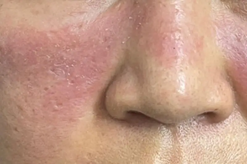 Nếu thấy da mặt bị đỏ sau tiêm filler thì cần chú ý