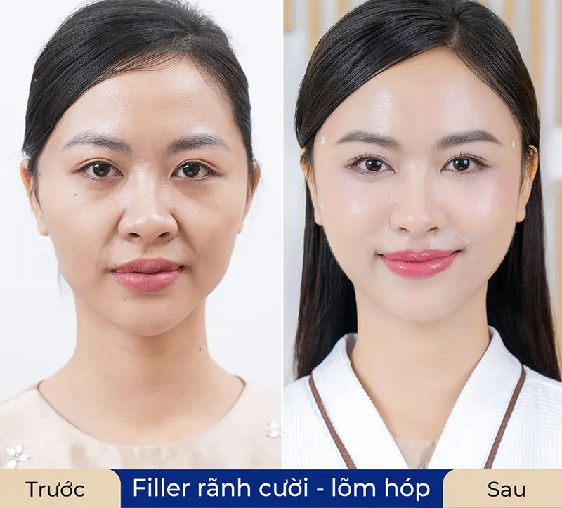Khách hàng sở hữu gương mặt tươi trẻ hơn sau khi tiêm filler rãnh cười và lấp đầy vùng da lõm hóp