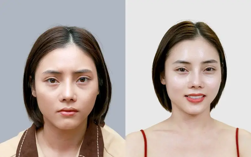 Sau khi HA liên kết với các mô da khuôn mặt của khách hàng căng bóng, tươi trẻ hơn