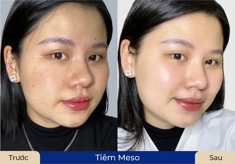 Tiêm HA giúp gương mặt tươi sáng, mờ thâm sạm và căng bóng hơn