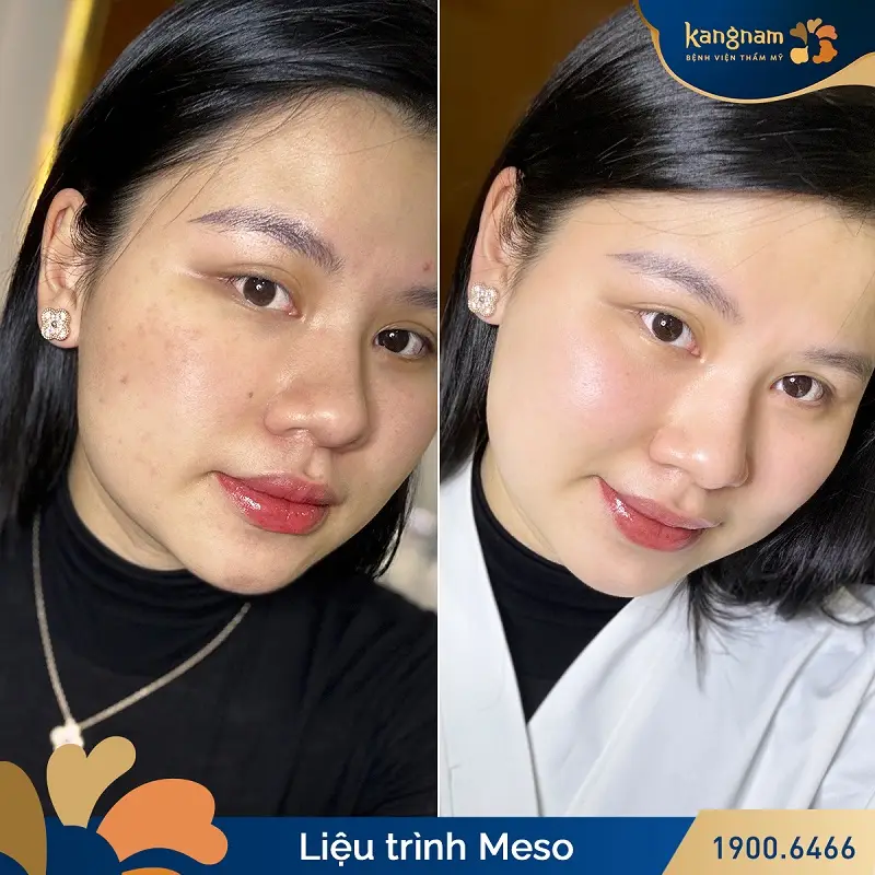 Khuôn mặt của khách hàng sáng mịn, tươi trẻ hết thâm nám sau khi tiêm meso tại Kangnam