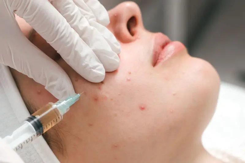Tiêm Meso trị mụn hiệu quả đối với tình trạng mụn nhẹ