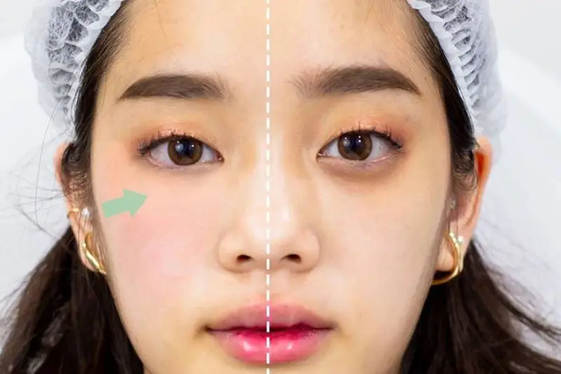 Chỉ vài phút tiêm meso, đánh bay dấu hiệu tuổi tác quanh mắt