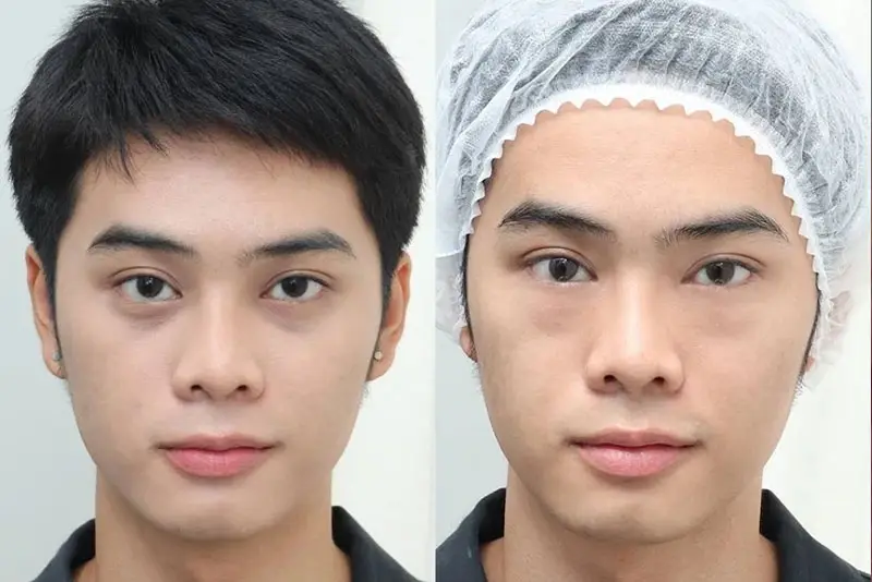 Đôi mắt bừng sáng chỉ sau vài buổi meso