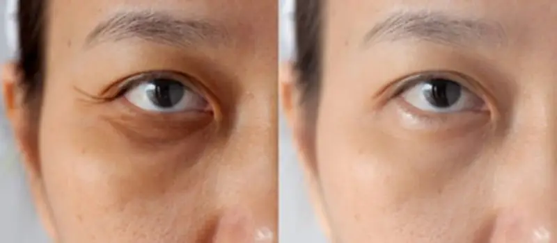 Tiêm meso trị thâm mắt có giá từ