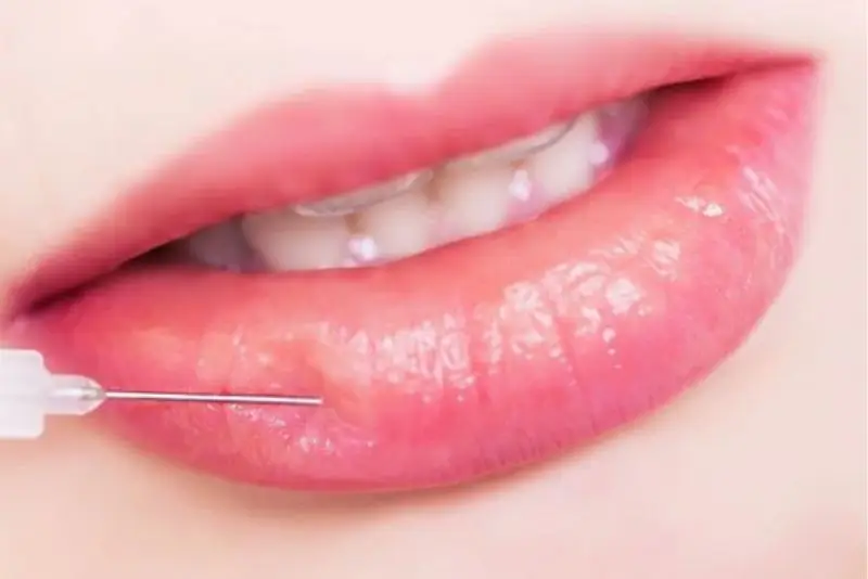 Tiêm tan filler sử dụng một loại enzyme gọi là hyaluronidase