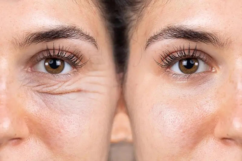 Tiêm xóa nhăn mắt không gây ảnh hưởng vùng mắt