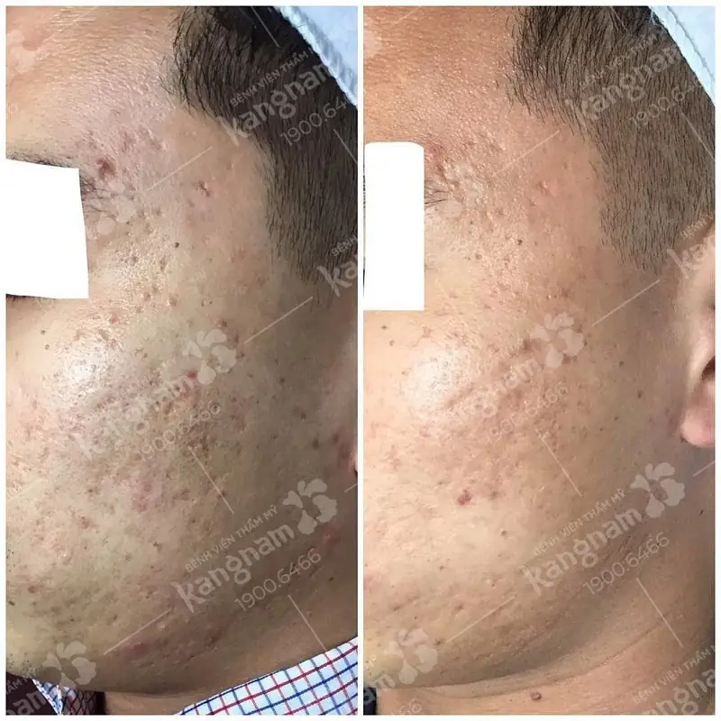 Hiệu quả trị sẹo thâm có thay đổi rõ rệt