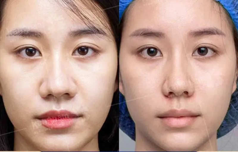 Hình ảnh trước và sau cắt cánh mũi