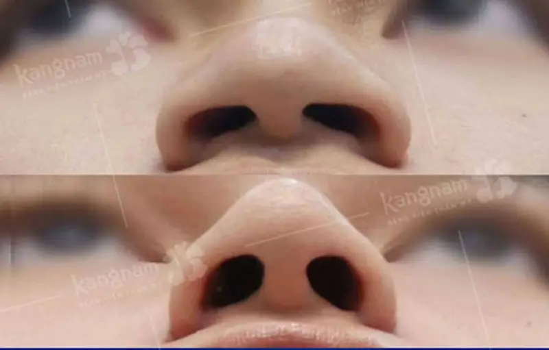 Cắt cánh mũi giúp mũi cân đối và thon gọn