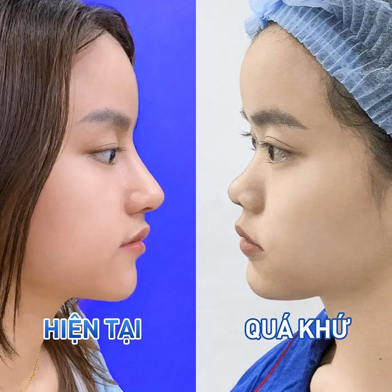 Tái tạo toàn diện cấu trúc mũi