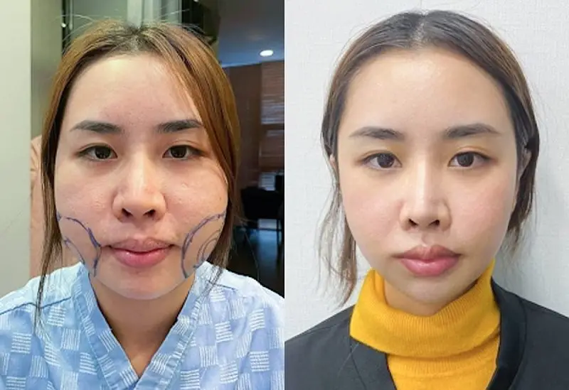Thông thường, từ đủ 18 tuổi trở lên khách hàng có thể hút mỡ