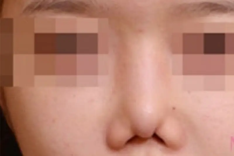 Mũi biến dạng do chỉ bị co rút