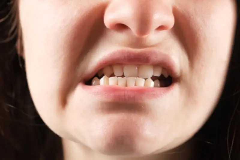 Lệch khớp cắn do bác sĩ chỉnh hàm sai vị trí