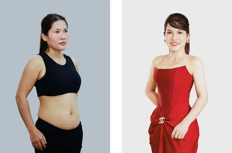 Hút mỡ bụng sẽ giúp vòng eo thon gọn tức thì
