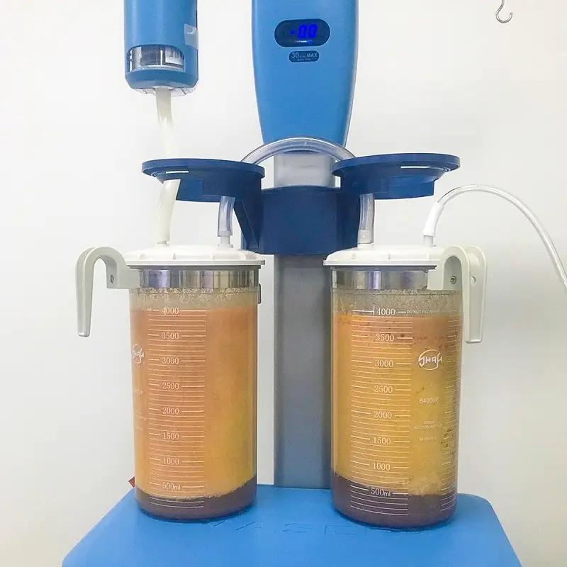 Mỡ bụng sau khi được hút ra ngoài