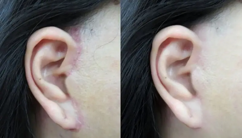 Nguy cơ để lại sẹo nếu không được thực hiện đúng kỹ thuật