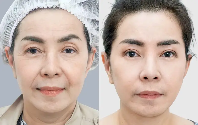 Căng da mặt giúp khắc phục tình trạng da bị chảy xệ, nhiều nếp nhăn