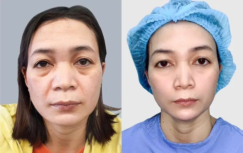 Thực hiện căng da mặt đúng cách giúp khách hàng sở hữu gương mặt trẻ trung, căng mịn