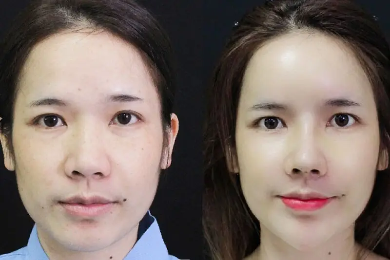 Cắt cánh mũi không làm mất lộc