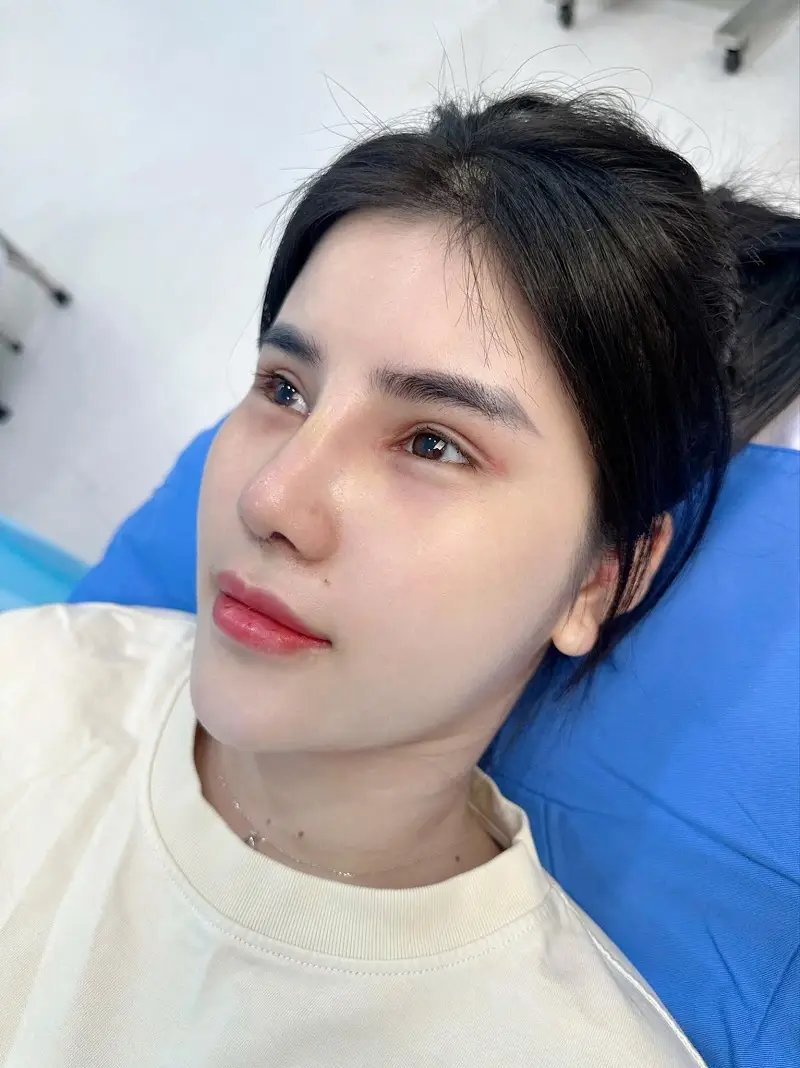 Cắt mí 10 ngày vết thương đã liền da, có thể cắt chỉ. Với một số trường hợp mắt vẫn sưng thường do cơ địa