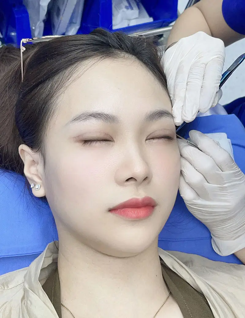 Sau 7 - 10 ngày cắt mí khách hàng có thể thực hiện cắt chỉ