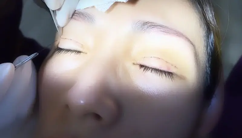 Bác sĩ sẽ tiến hành gắp bỏ sợi chỉ còn sót lại ở mí mắt