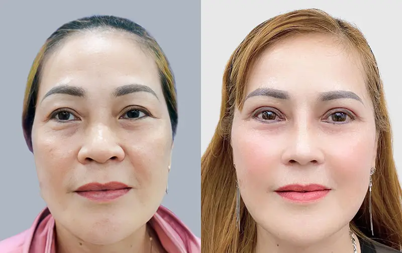 Phương pháp cắt mí không duy trì được hiệu quả vĩnh viễn