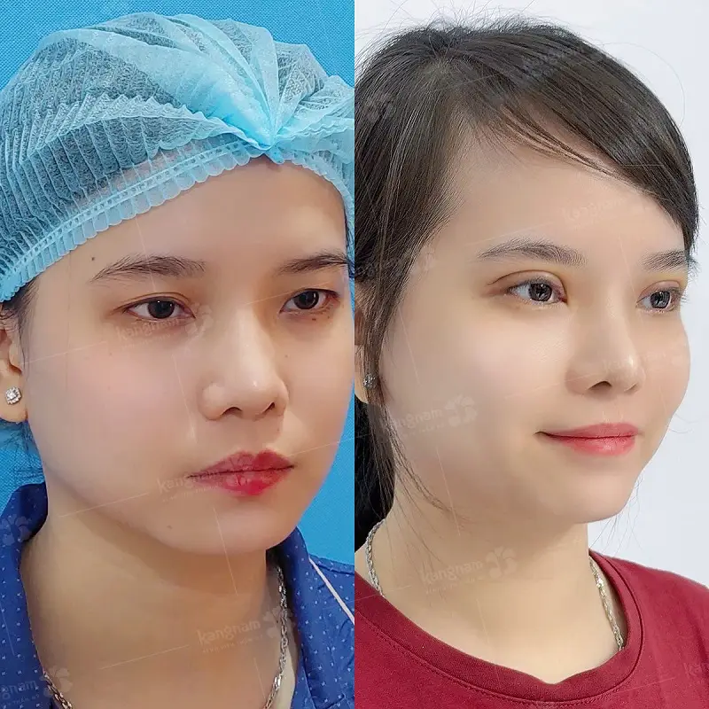 Mắt 2 mí sau cắt có độ to vừa phải, cân đối với tổng thế gương mặt khách hàng