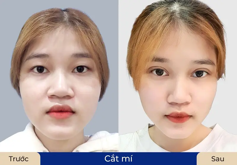 Đường mí mắt rõ nếp, không quá sâu, không quá to