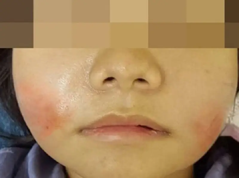 Mỡ vón cục ở vị trí cấy mỡ gây đau nhức, khó chịu