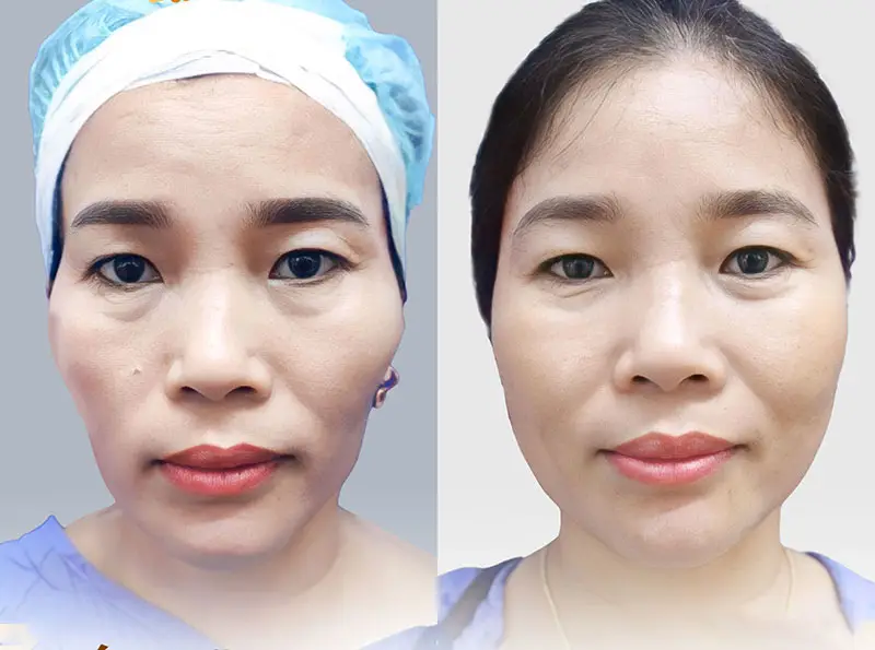 Cấy mỡ lên mặt duy trì hiệu quả từ 2 - 3 năm