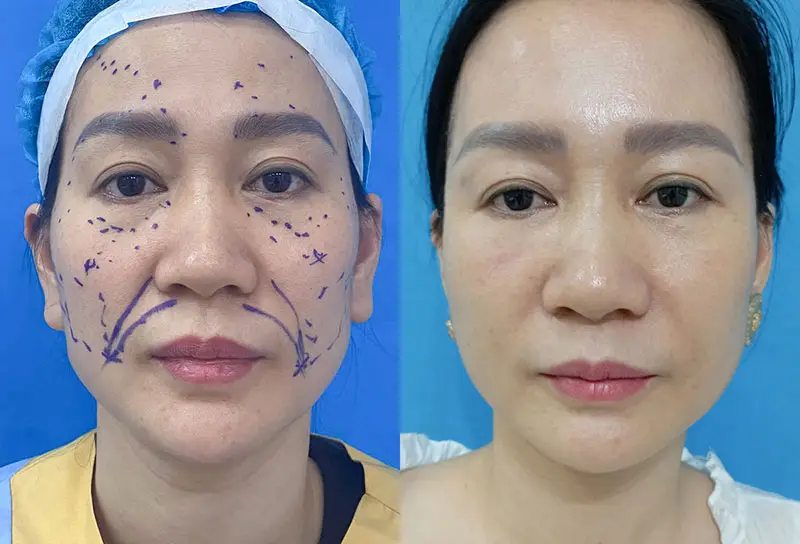 Cấy mỡ mặt bằng mỡ tự thân sử dụng mỡ thừa từ cơ thể khách hàng để tăng thể tích vùng khuyết thiếu