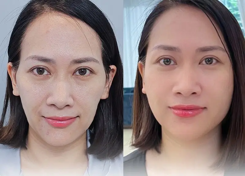 Những người có cơ địa nhanh lành vùng mặt sẽ nhanh phục hồi và đẹp tự nhiên sớm hơn