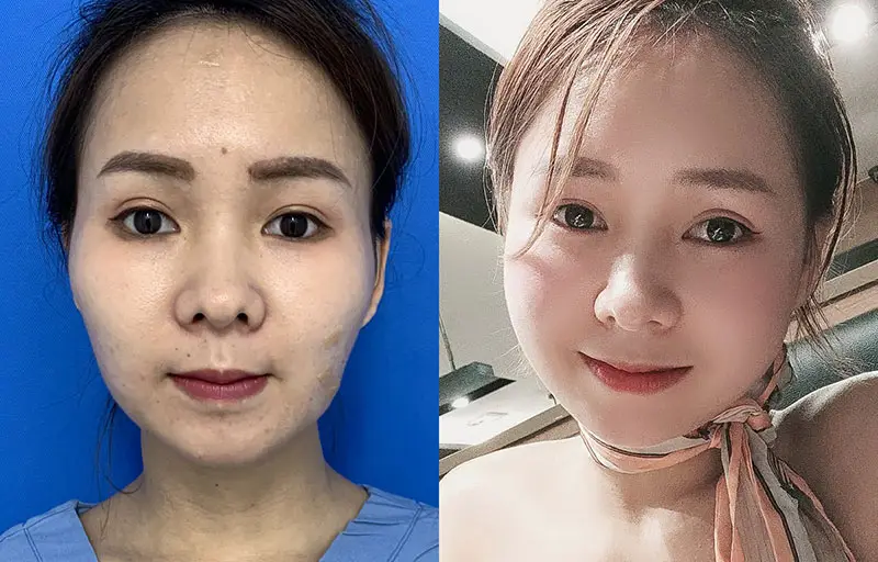 Cấy mỡ mặt an toàn khi được thực hiện tại địa chỉ thẩm mỹ uy tín