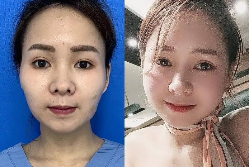 Ứng dụng công nghệ cấy mỡ hiện đại giúp khách hàng duy trì khuôn mặt đầy đặn lâu dài