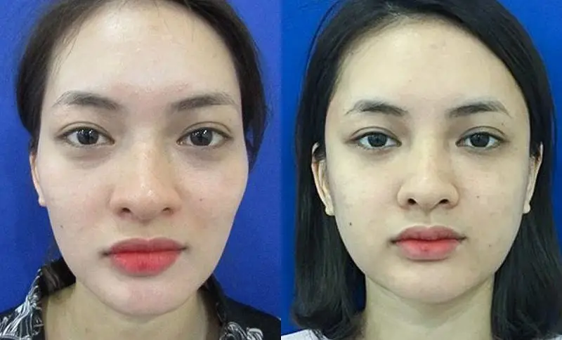 Khuôn mặt trẻ trung, sáng mịn hơn sau cấy mỡ mặt