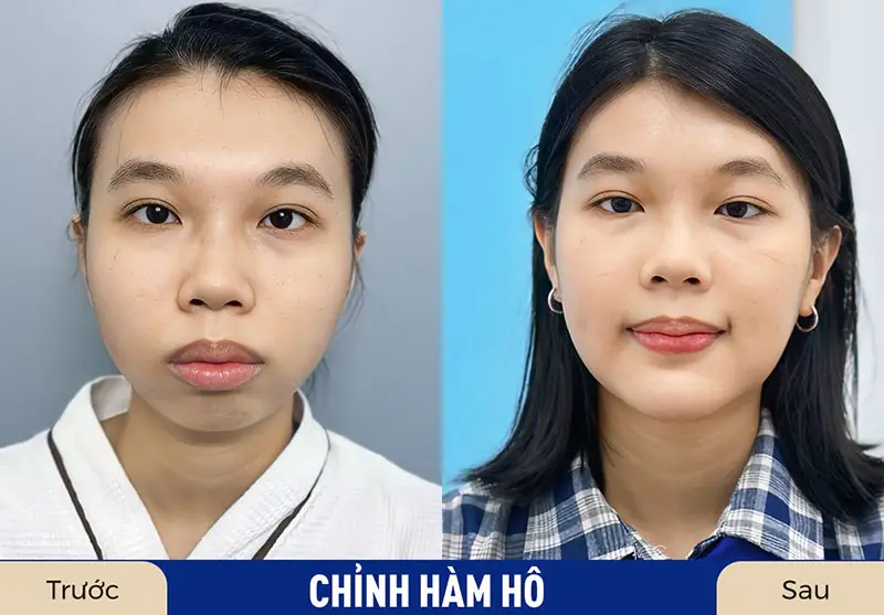 Khách hàng sở hữu gương mặt thanh tú sau khi chỉnh hàm hô