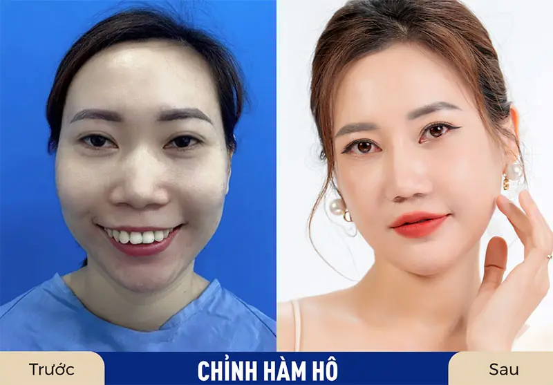 Khách hàng trước và sau khi chỉnh hô hàm trên