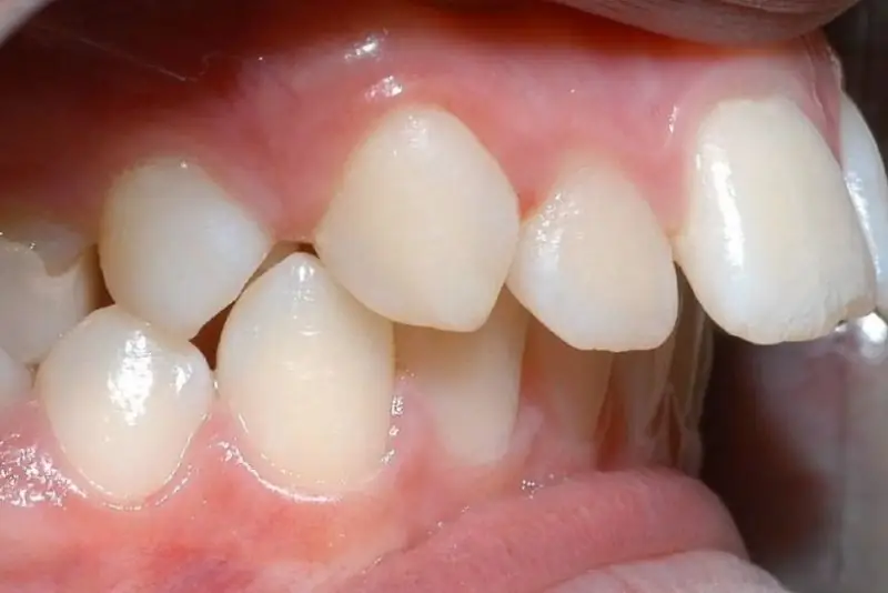 Tình trạng hô nhẹ do răng mọc chìa