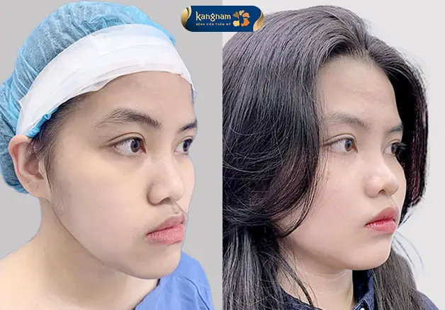 Tình trạng móm ngược trước và sau khi chỉnh sửa