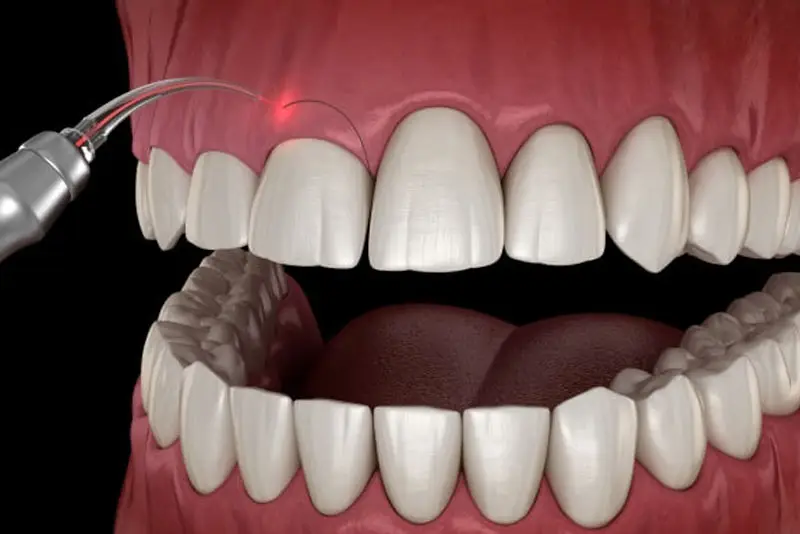 Cắt lợi chữa cười hở lợi là phương pháp an toàn