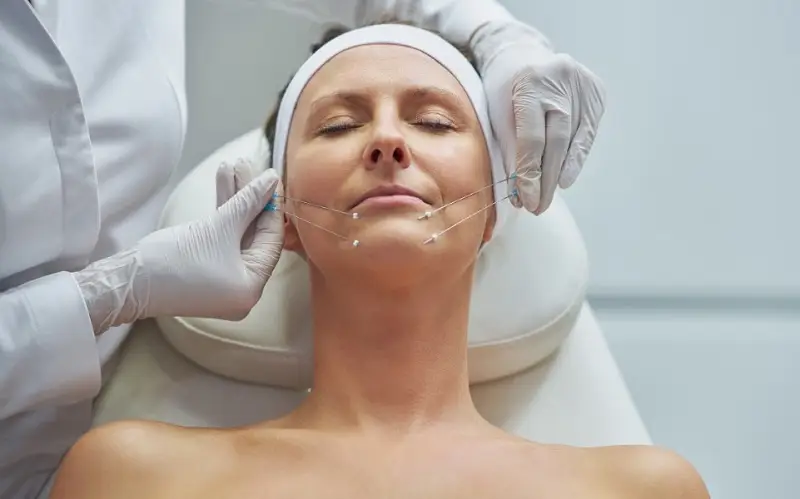 Công nghệ căng chỉ collagen tạo mạng lưới nâng đỡ da