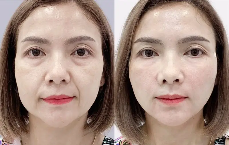 Căng chỉ collagen giúp khắc phục tình trạng da chảy xệ, nhăn nheo, da lão hóa
